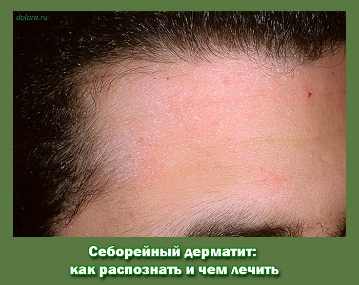 Себорейный дерматит