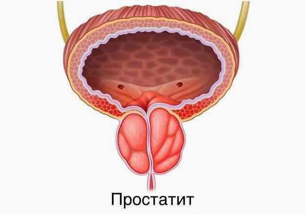 Простатит - лечение простатита симптомы и признаки