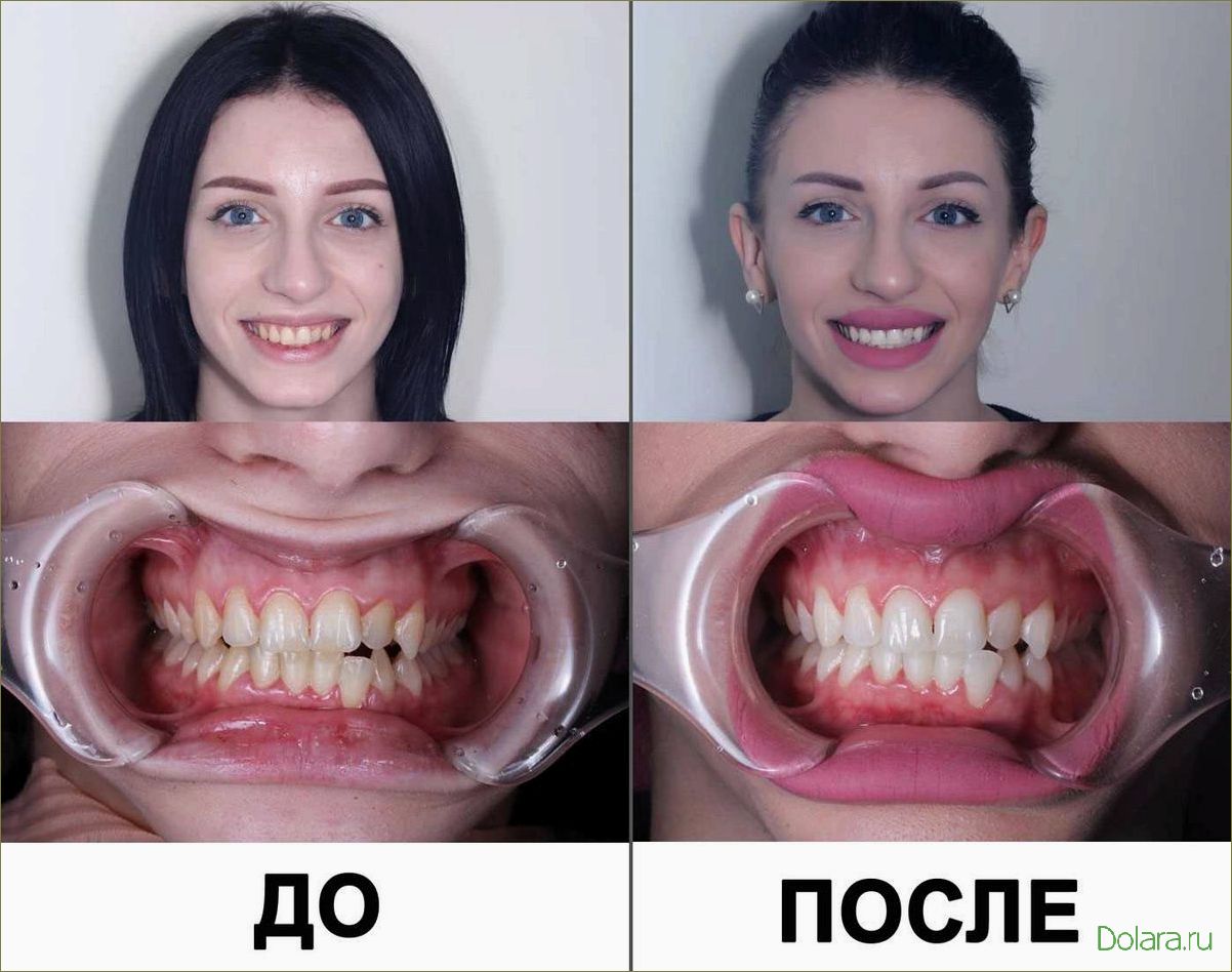 Отбеливание зубов Zoom: эффективные методы и процедуры
